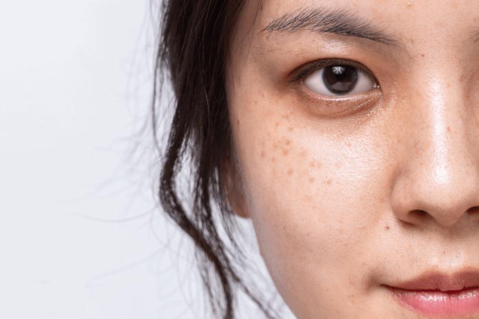 양측성 모반양 반점