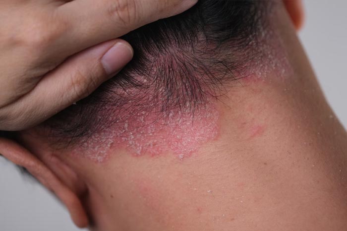 건선 (Psoriasis)