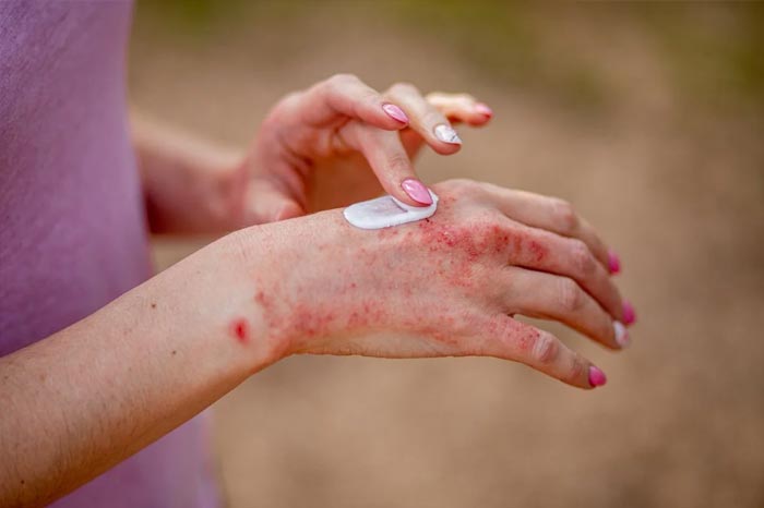 반복되는 건선 증상, 완화를 위한 피부 관리법