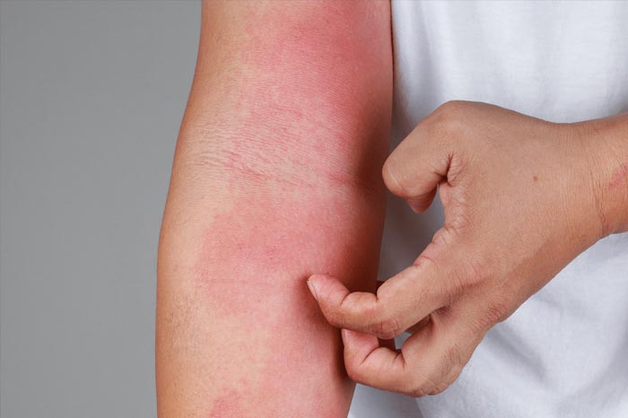 알레르기인가요? 접촉성 피부염 예방과 대응 팁