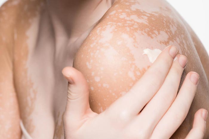 백반증은 감염병이 아닙니다 – 오해와 진실