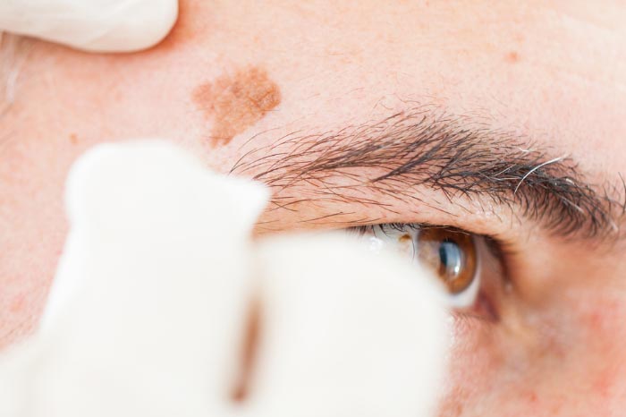 검버섯은 왜 생기나? 원인과 예방법 총정리